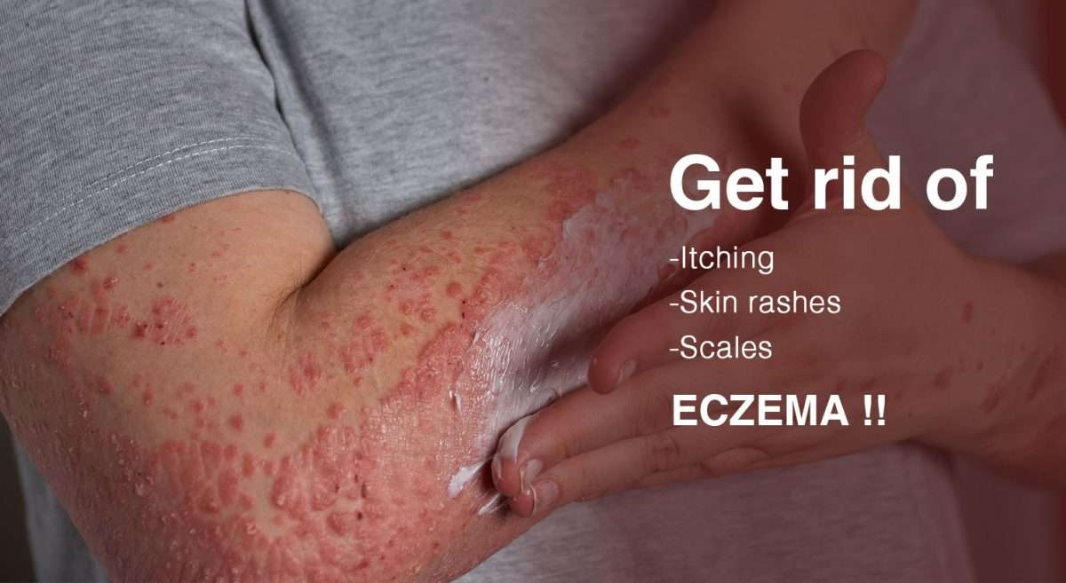 How-to-Manage-Eczema-through-Ayurveda-1200x657.jpg