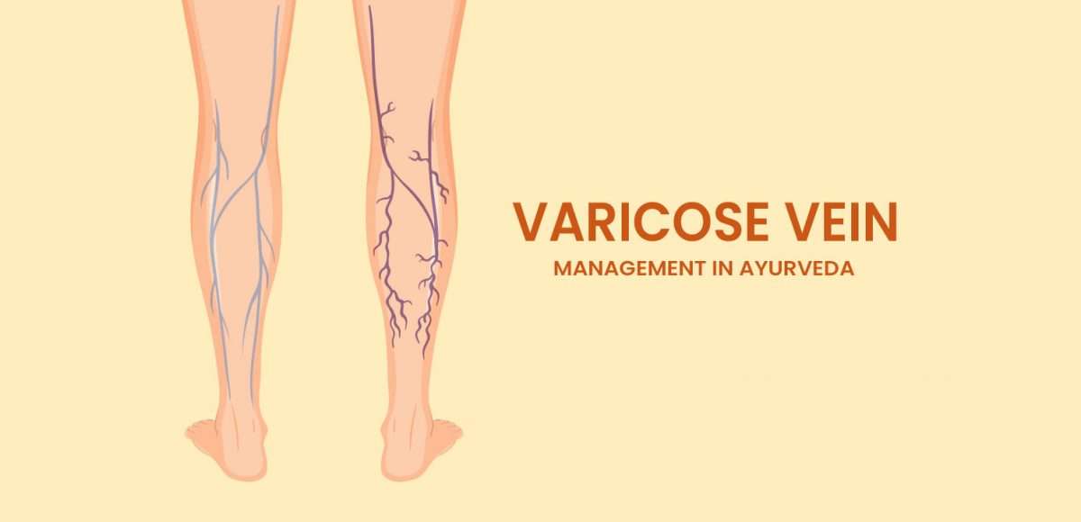 Varicose-vein-management-in-Ayurveda-1200x580.jpg