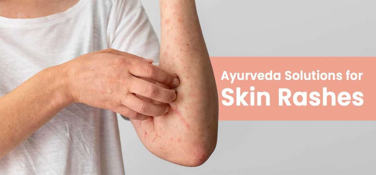 Ayurveda-Solutions-for-Skin-Rashes-1200x560.jpg