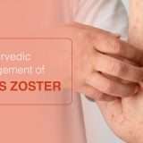 ayurvedic-treatment-herpes-zosteres zoster
