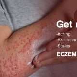 eczema-treatment-ayurveda