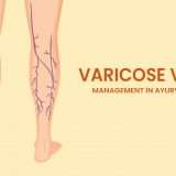 varicose-vein-ayurveda-treatment