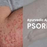 psoriasis-ayurvedic-treatment-melbourne